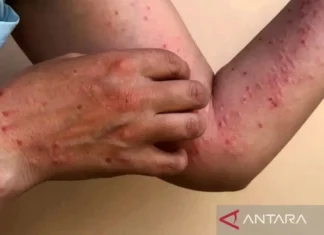 Kemenkes Siapkan 4.450 Dosis Vaksin Guna Cegah Cacar Monyet