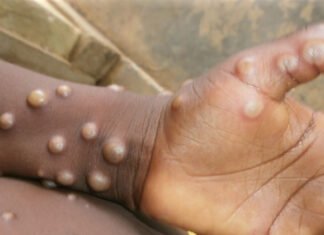 WHO Nyatakan Mpox Sebagai “Darurat Kesehatan yang Meresahkan Dunia”
