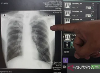 Kemenkes Deteksi 889 Ribu Orang Terjangkit TB per Maret 2025